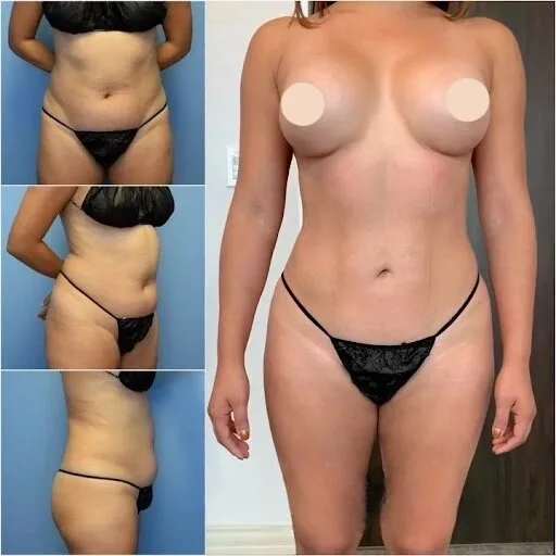Best Body Contouring Surgeons In Dubai For Targeted Body Sculpting Solutions